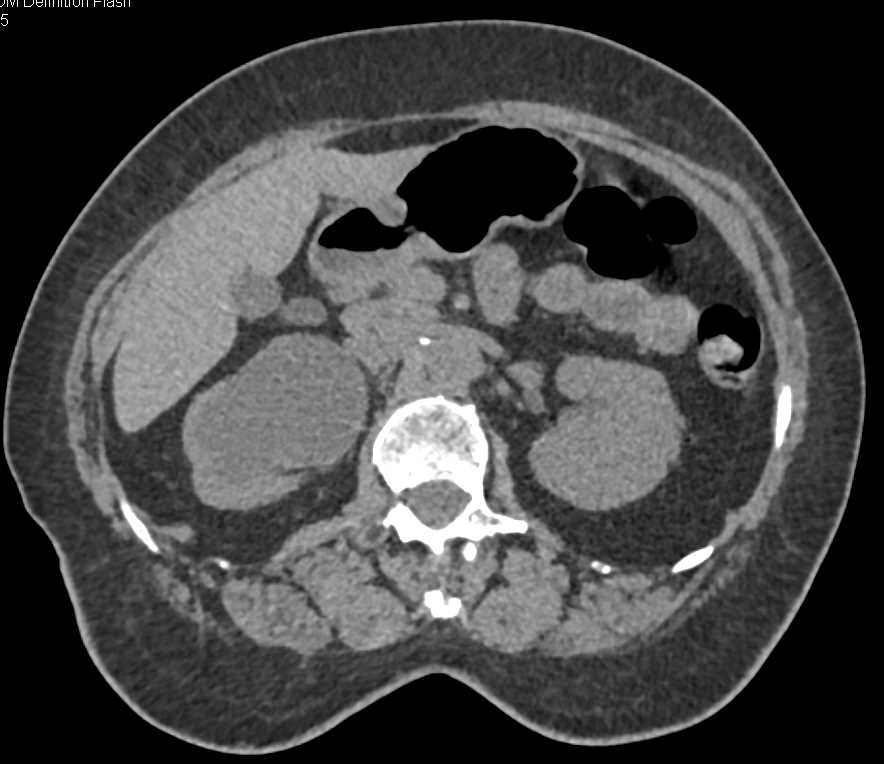 Obstructed Right Kidney due to a Transitional Cell Cancer (TCC) of the Ureter - CTisus CT Scan