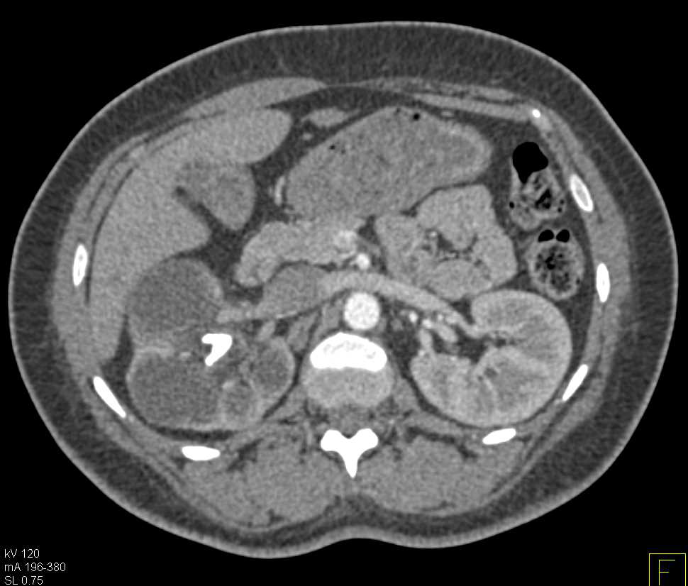 Xanthogranulomatous Pyelonephritis (XGP) Right Kidney - CTisus CT Scan