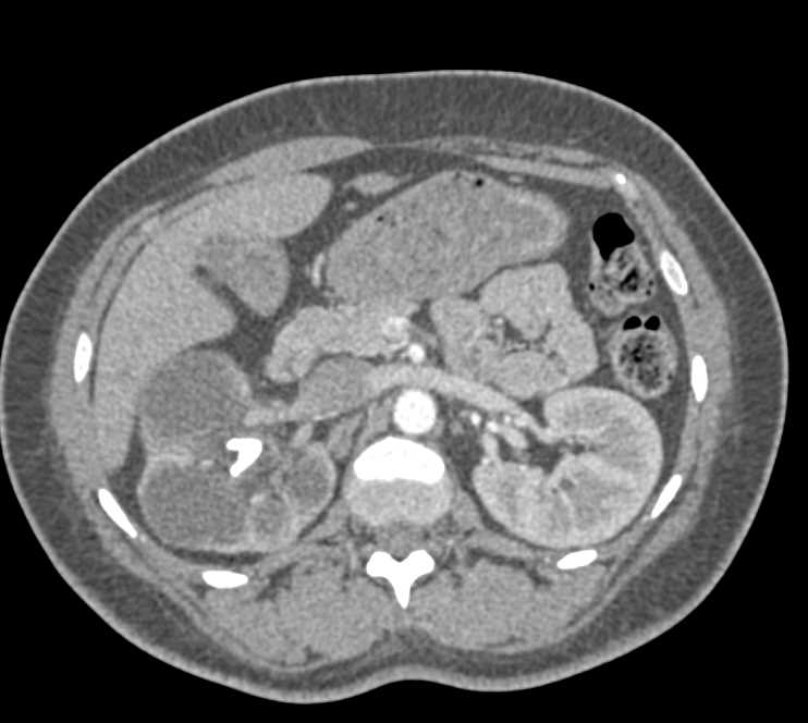 Xanthogranulomatous Pyelonephritis (XGP) Right Kidney - CTisus CT Scan