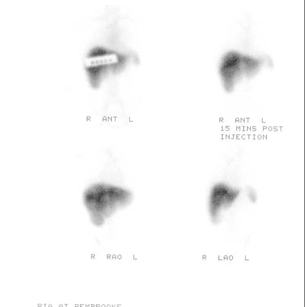 Renal Angiomyolipoma - CTisus CT Scan