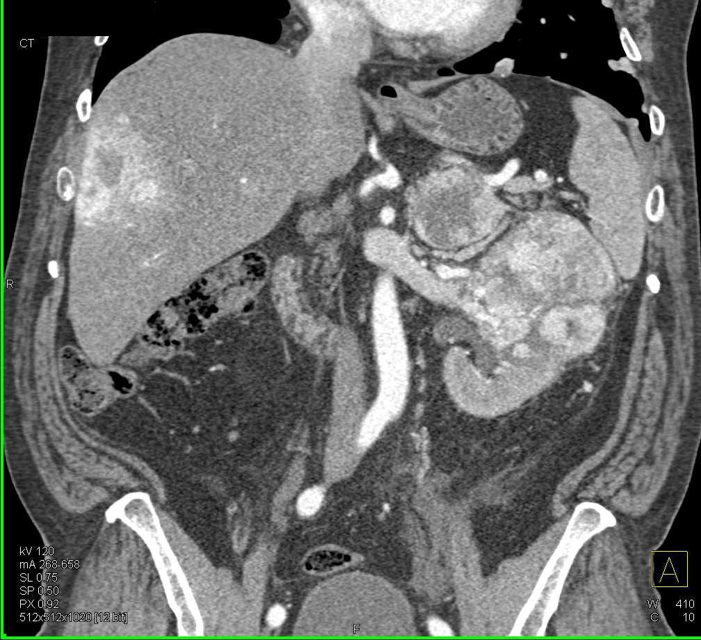 Clear Cell Renal Cell Carcinoma (RCC) Metastatic to the Liver and Left Adrenal Gland - CTisus CT Scan