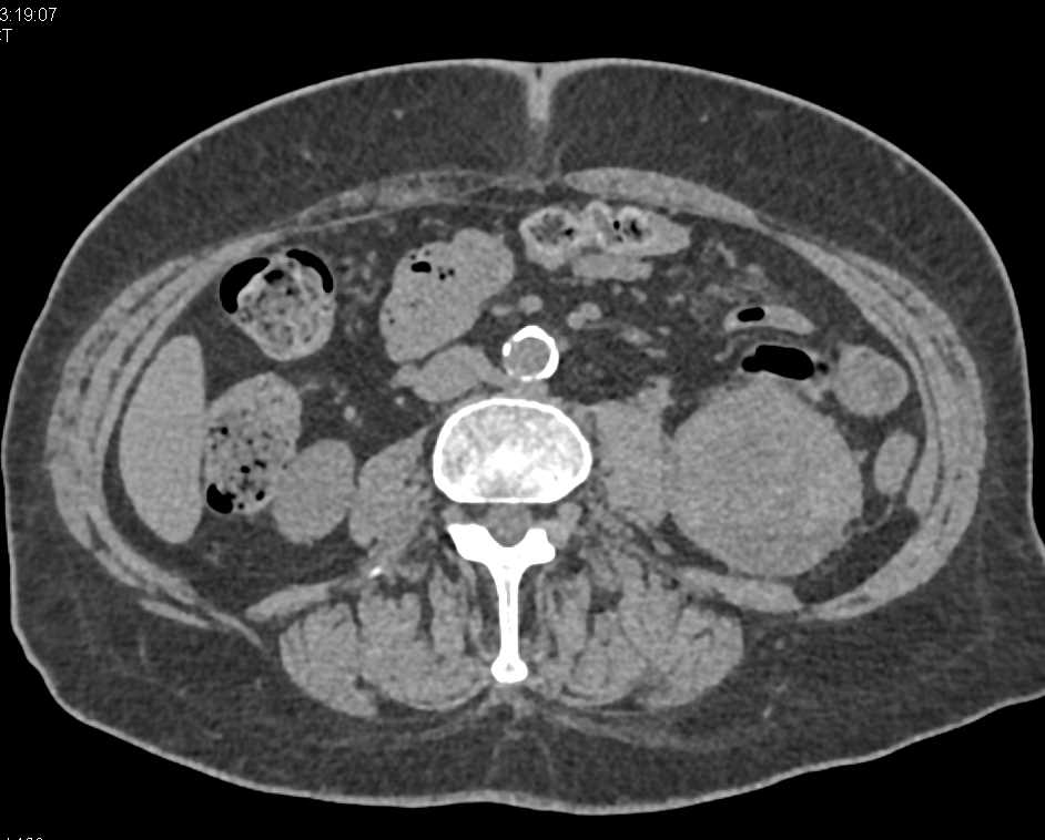 Clear Cell Renal Cell carcinoma Lower Pole Left Kidney - CTisus CT Scan