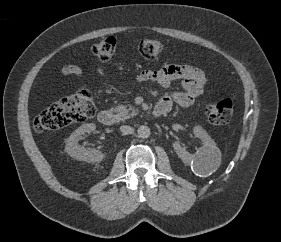 Bosniak 2F Cyst Left Kidney - Kidney Case Studies - CTisus CT Scanning