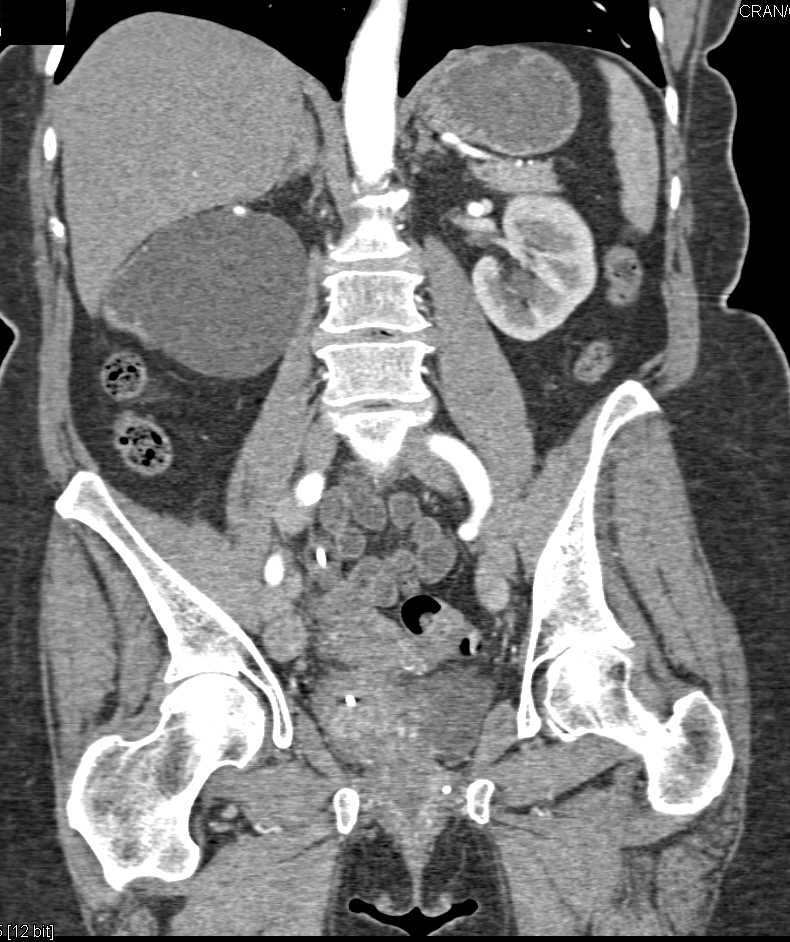 Obstructed Right Kidney With Minimal Renal Function - CTisus CT Scan