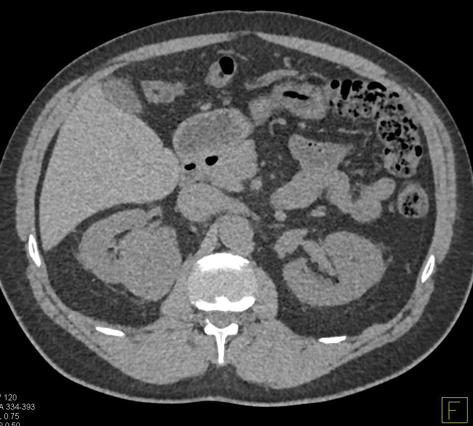 Papillary Renal Cell Carcinoma - CTisus CT Scan