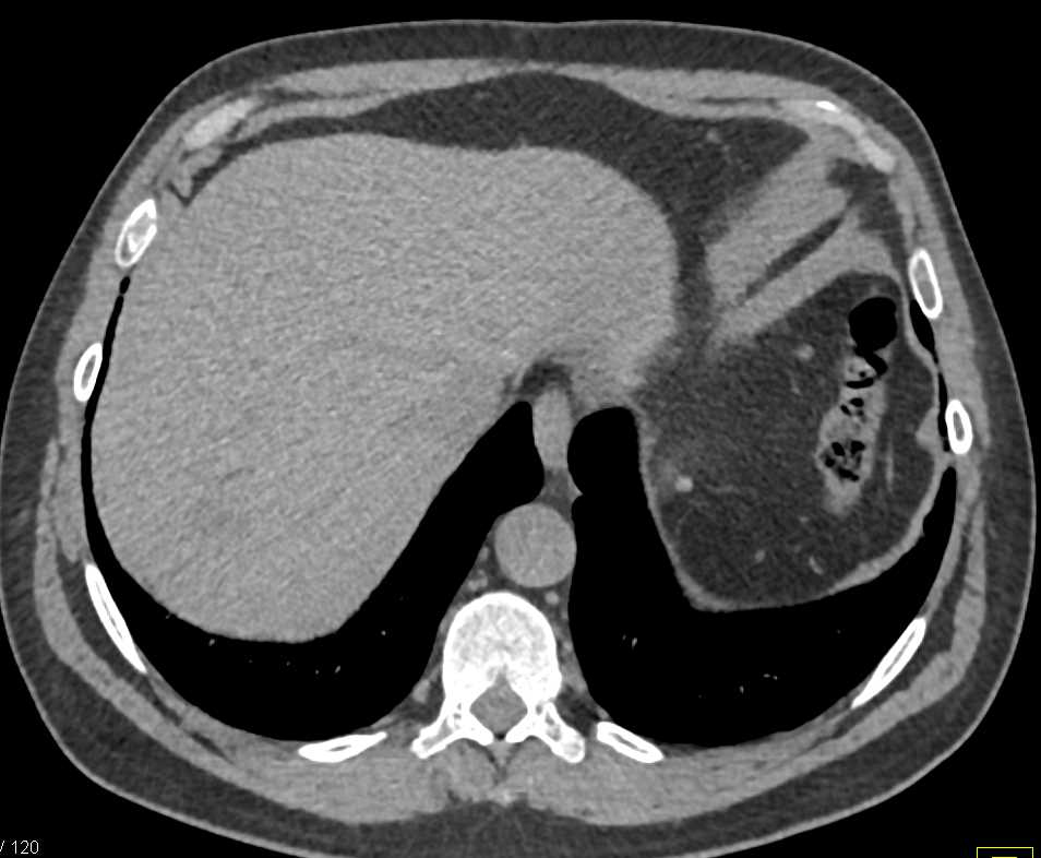 Papillary Renal Cell Carcinoma - CTisus CT Scan