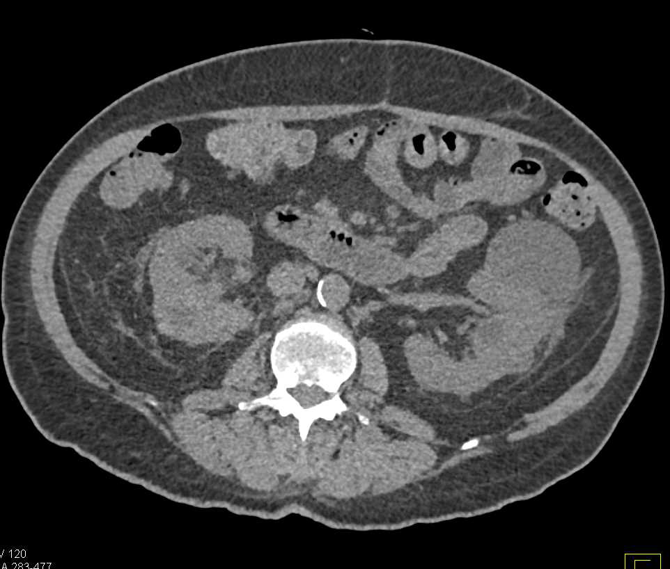 Bilateral Multifocal Renal Cell Carcinoma - CTisus CT Scan