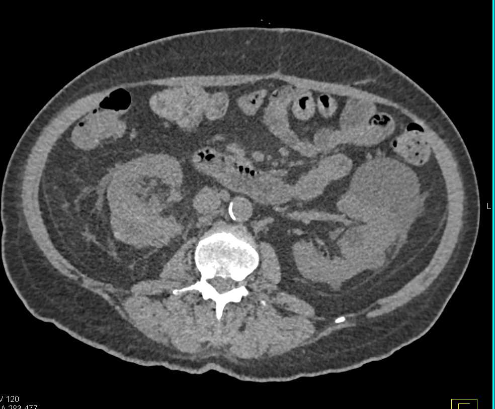 Bilateral Multifocal Renal Cell Carcinoma and Transitional Cell Cancer (TCC) Right Kidney - CTisus CT Scan