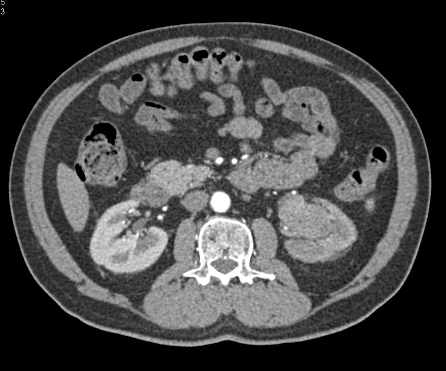 Transitional Cell Carcinoma Left Kidney - CTisus CT Scan