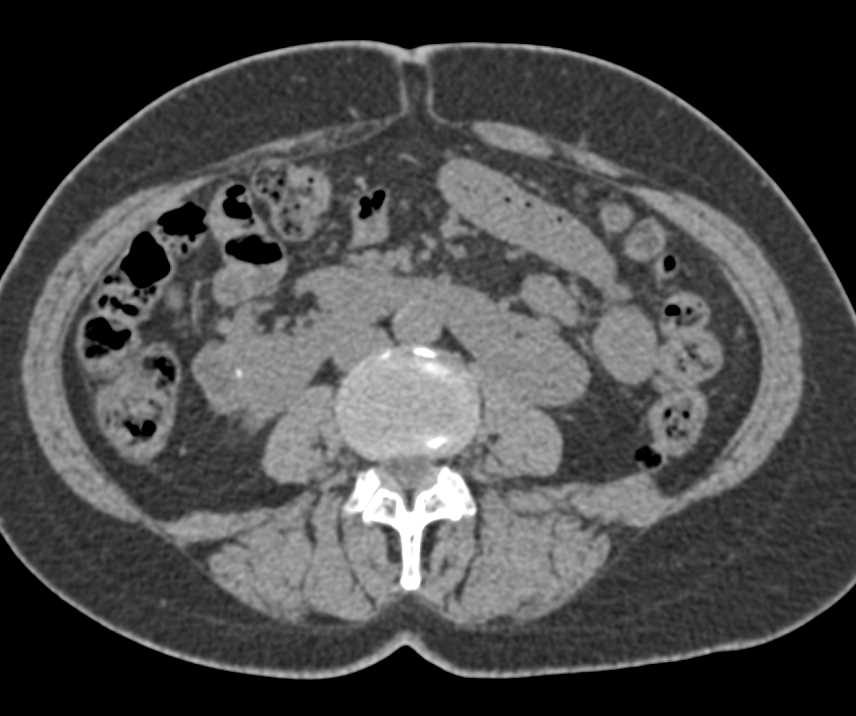 Horseshoe Kidneys with Cysts - CTisus CT Scan