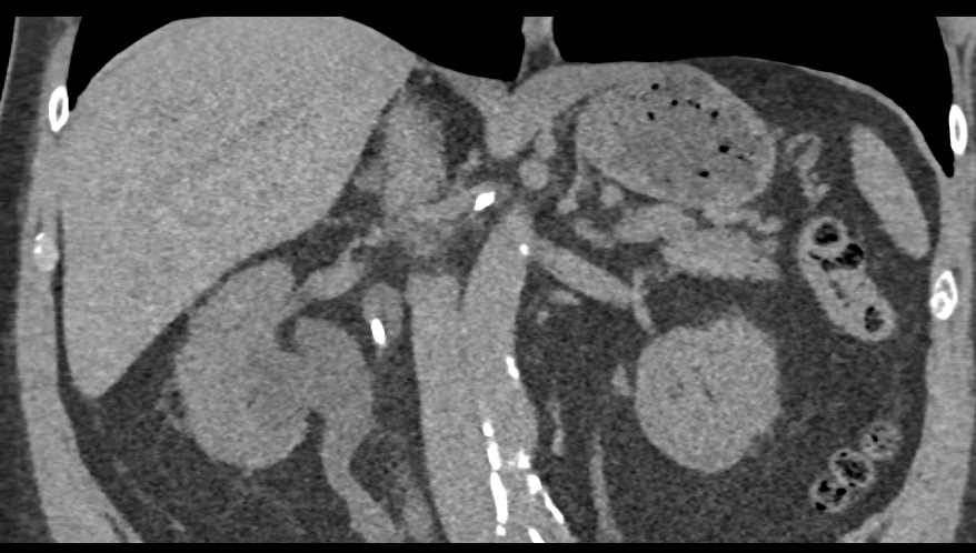 Duplicated Collecting System Right Kidney - CTisus CT Scan