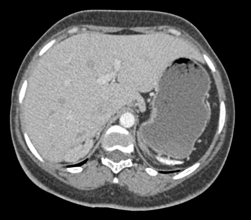 Papillary Necrosis in Sickle Cell Disease - CTisus CT Scan