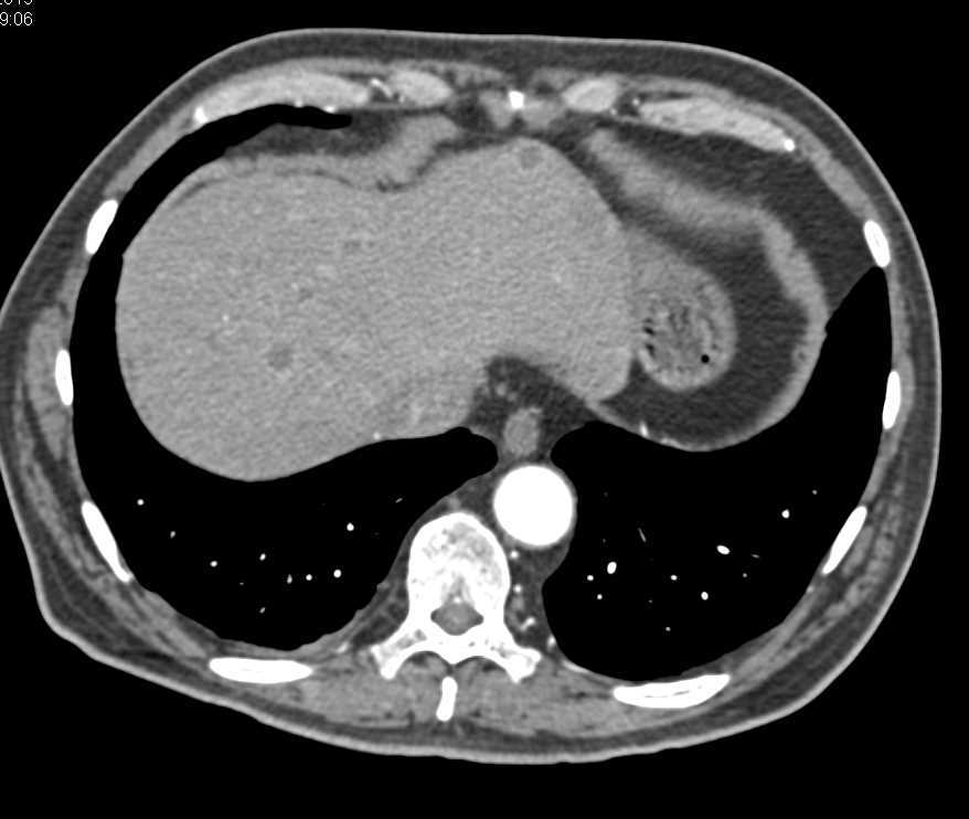 Metastatic Renal Cell Carcinoma to the Pancreas and Liver - CTisus CT Scan