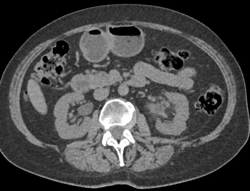 Transitional Cell Carcinoma Left Kidney and Ureter - CTisus CT Scan