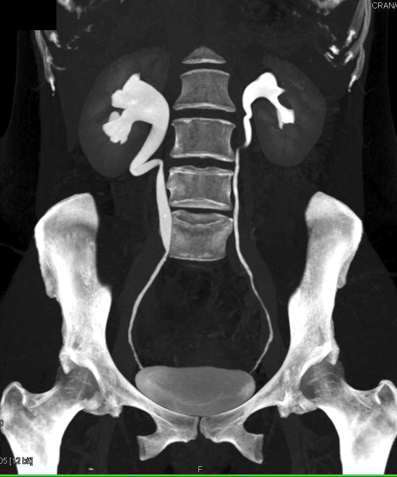 Mild Stricture in the Right Ureter - CTisus CT Scan