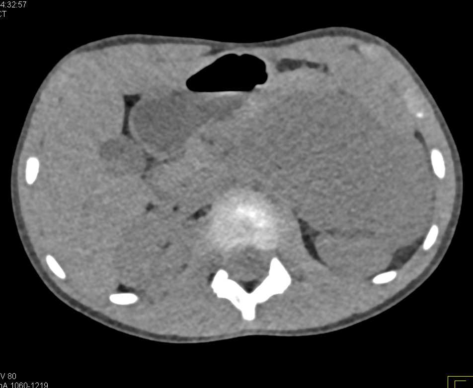 Left Upper Quadrant Hematoma Following Surgery - CTisus CT Scan