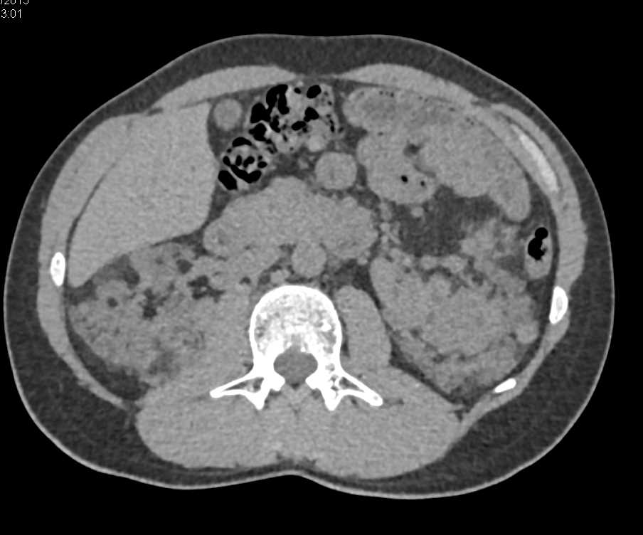 Multiple Bilateral Renal Angiomyolipoma (AMLs) and Osteomas Sacrum ...