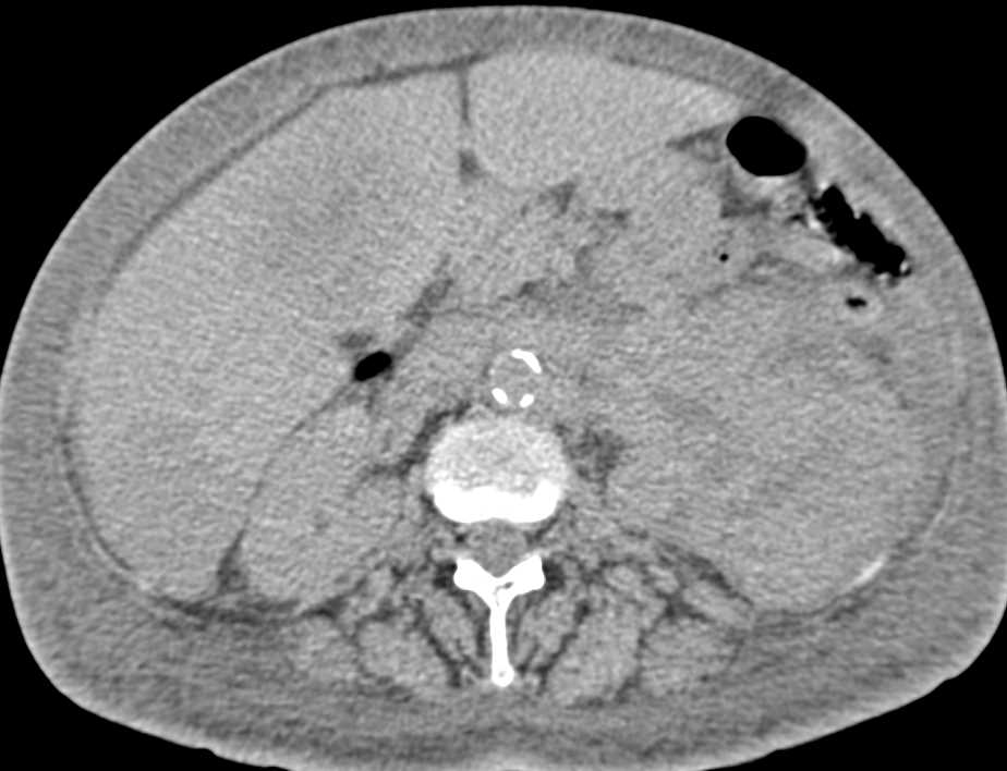 Renal Lymphoma with Liver Metastases - CTisus CT Scan