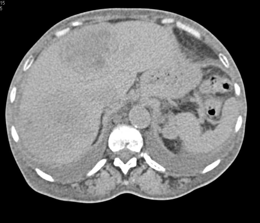 Renal Lymphoma with Liver Metastases - CTisus CT Scan