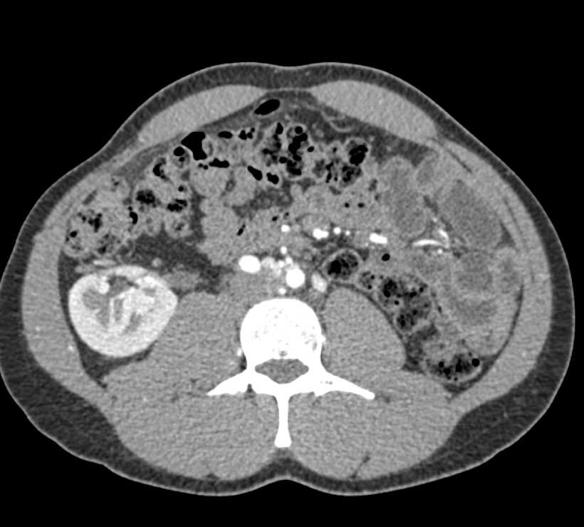 Pelvic Kidney is Nearly Perfectly Central - CTisus CT Scan