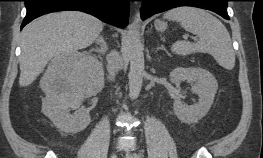 Renal Cell Carcinoma Right Kidney - CTisus CT Scan