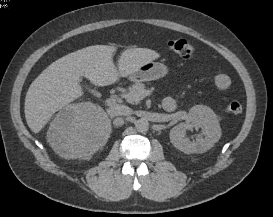 Renal Cell Carcinoma Right Kidney with Adenopathy - CTisus CT Scan