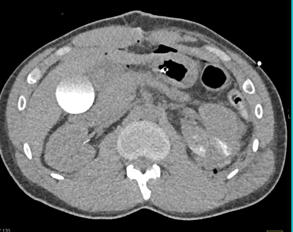 Laceration Left Kidney with Perirenal Blood - CTisus CT Scan