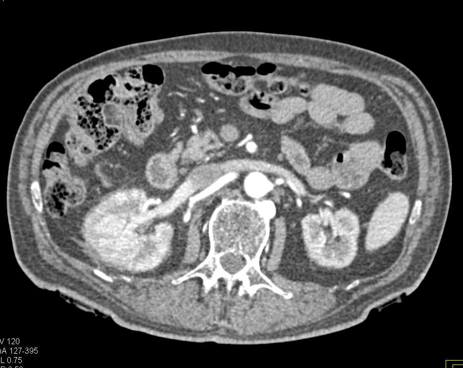 Striated Nephrograms and Acute Pyelonephritis Right Kidney - CTisus CT Scan