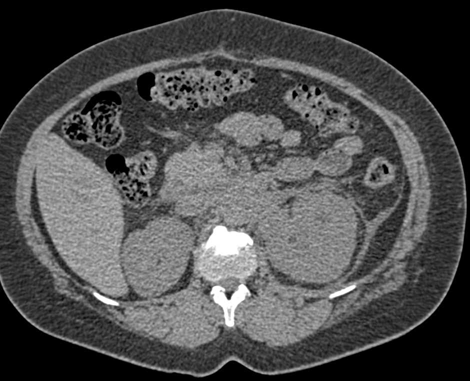 Transitional Cell Carcinoma Left Kidney - CTisus CT Scan