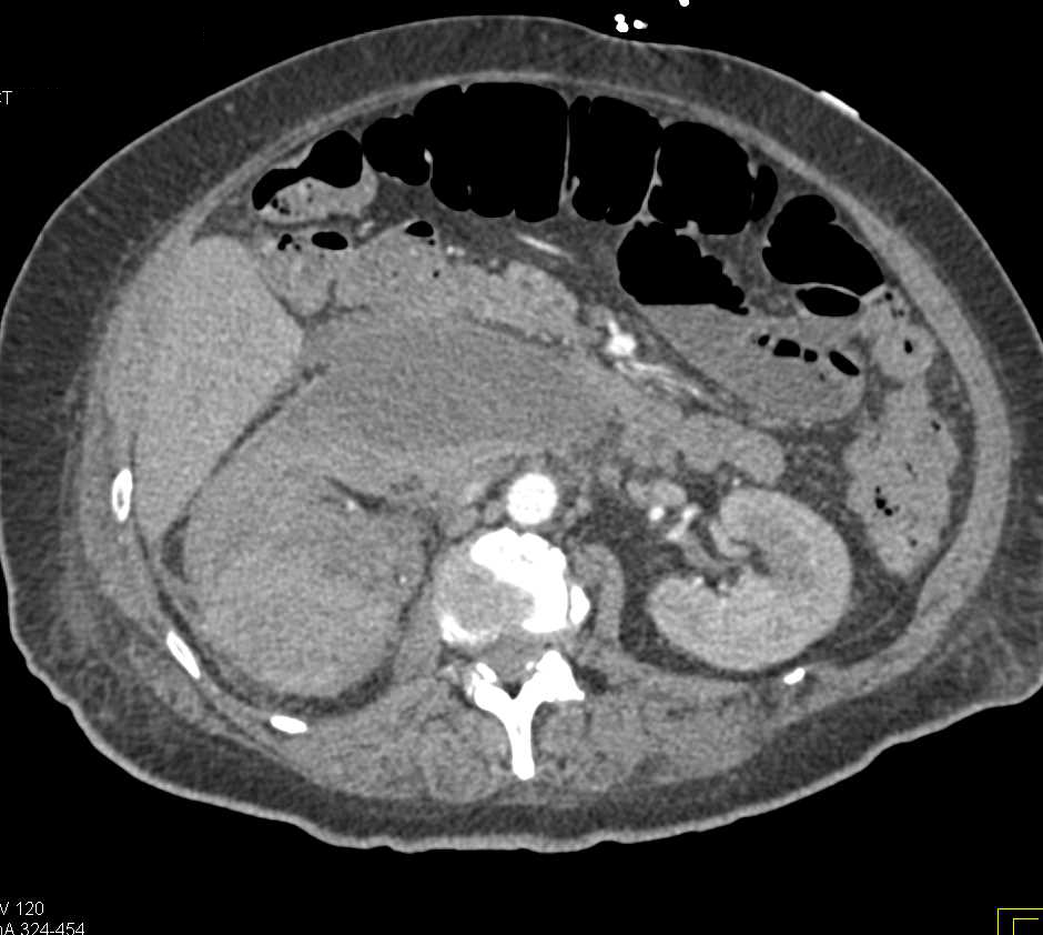 Poorly Functioning Right Kidney Following Recent Trauma - CTisus CT Scan