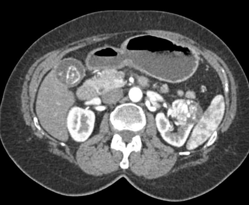 Clear Cell Renal Cell Carcinoma (RCC) Left Kidney - CTisus CT Scan