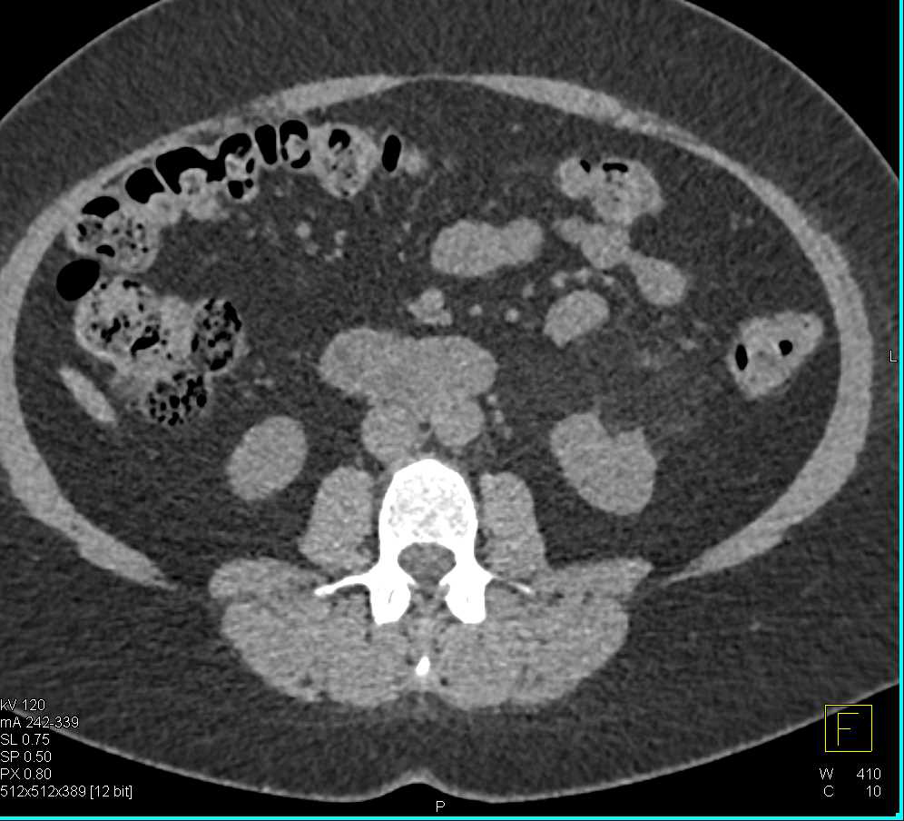 Angiomyolipoma of the Left Kidney - CTisus CT Scan