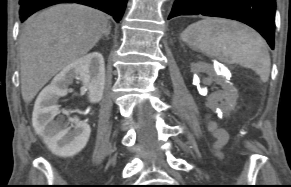 Calcified Atrophic Left Kidney - CTisus CT Scan