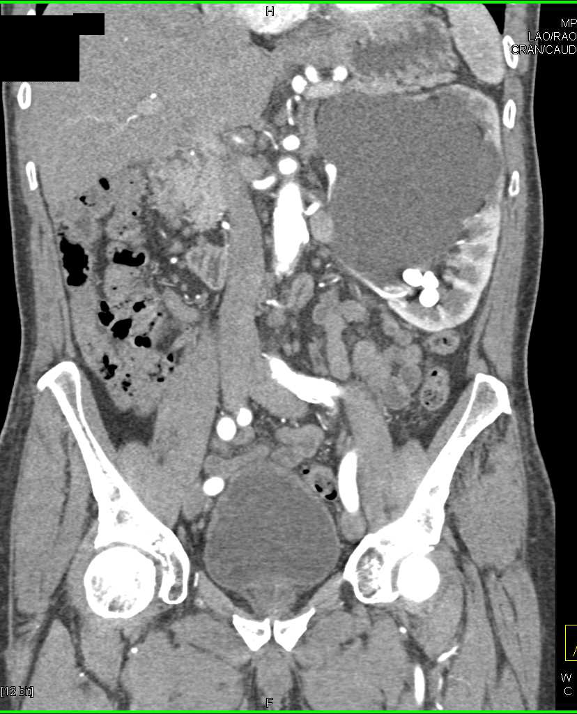 Large Parapelvic Cyst Left Kidney - CTisus CT Scan