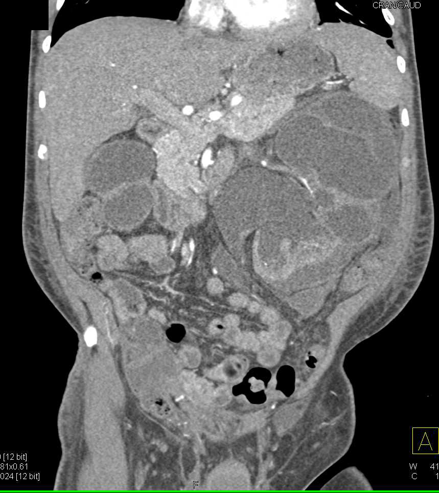 End Stage Renal Disease (ESRD) - CTisus CT Scan