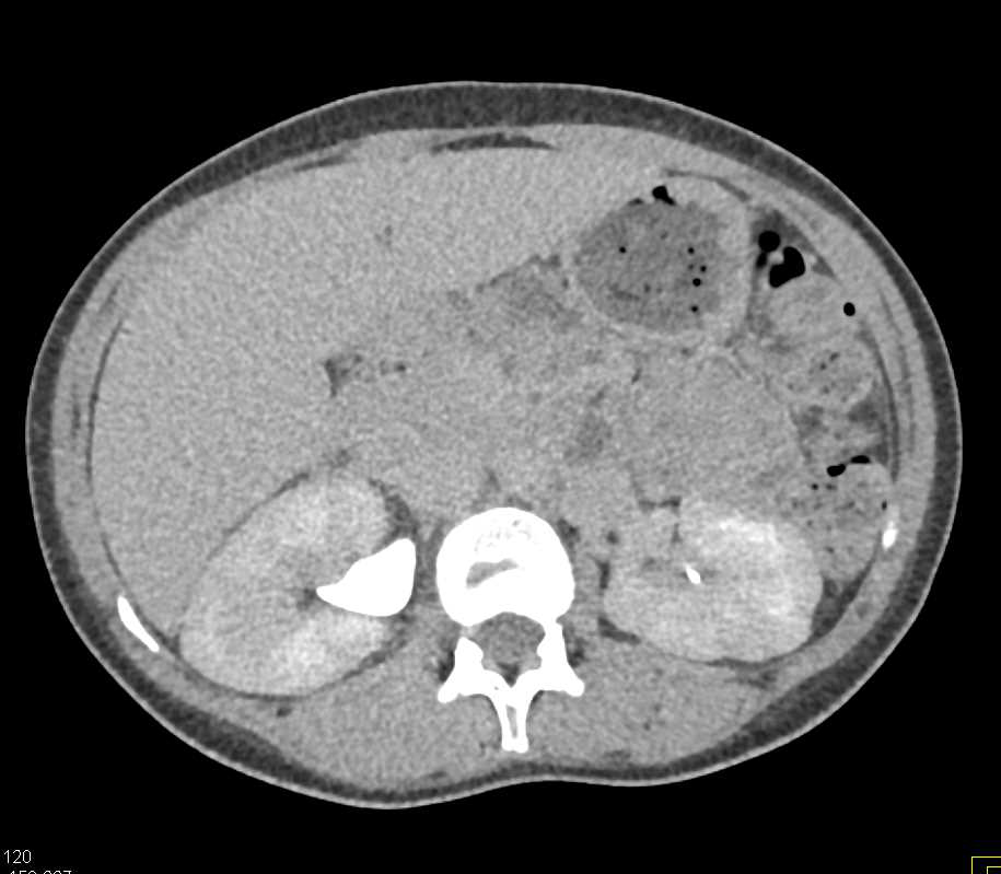 Papillary Necrosis in a Patient with Sickle Cell Disease - CTisus CT Scan