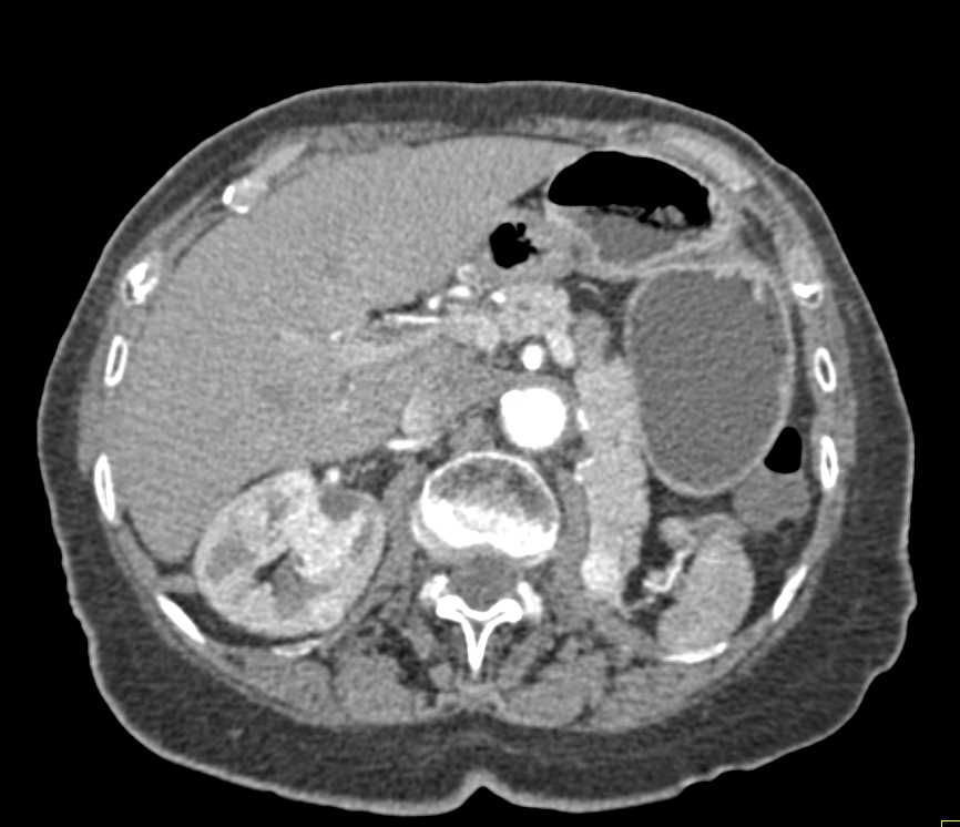 Recurrent Renal Cell Carcinoma with Metastases to Kidney, pancreas , bone and muscle. - CTisus CT Scan