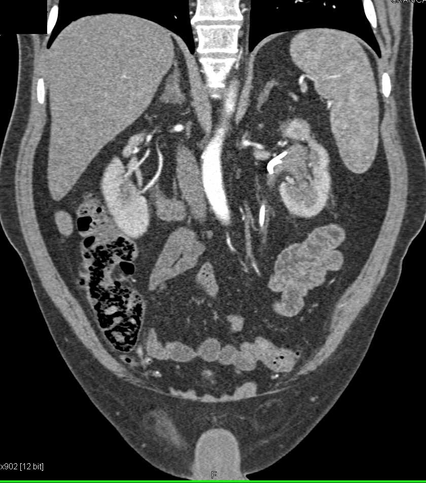 Transitional Cell Carcinoma Left Kidney - CTisus CT Scan