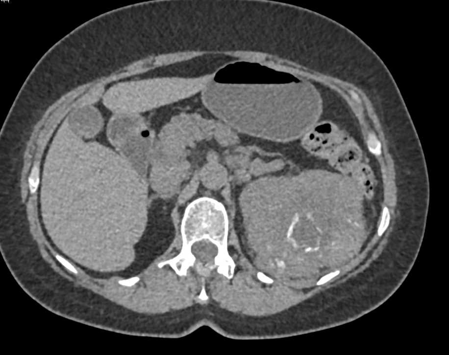 Clear Cell Left Renal Cell Carcinoma with Arteriovenous (AV) Shunting and Lung Metastases - CTisus CT Scan