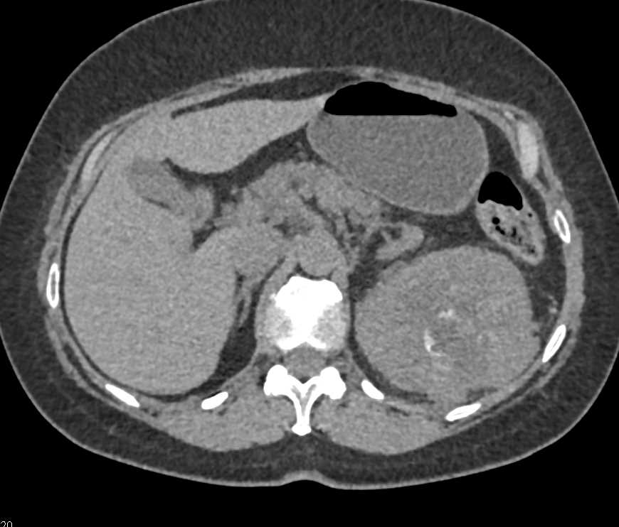 Clear Cell Left Renal Cell Carcinoma with Arteriovenous (AV) Shunting and Neovascularity - CTisus CT Scan