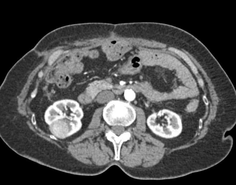 Oncocytoma Right Kidney - CTisus CT Scan