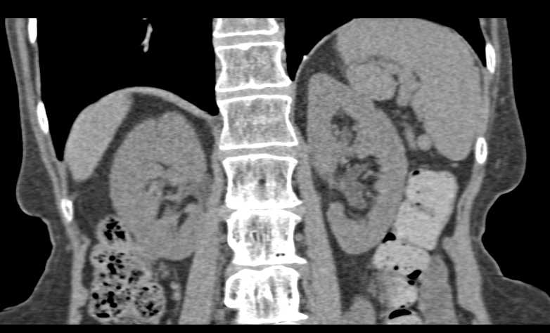 Obstructed Left Ureter by Uterine Fibroid - CTisus CT Scan