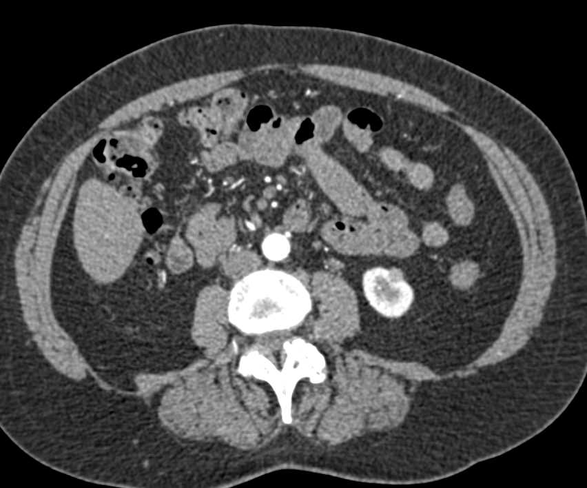 1cm Renal Call Carcinoma Left Kidney - CTisus CT Scan