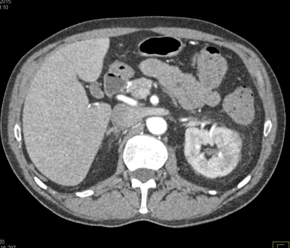 Acute Pyelonephritis Left Kidney Kidney Case Studies Ctisus Ct Scanning