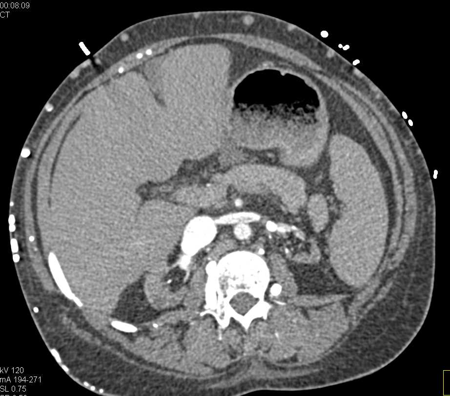 End Stage Renal Disease (ESRD) with Failed Transplant in the Right Lower Quadrant - CTisus CT Scan