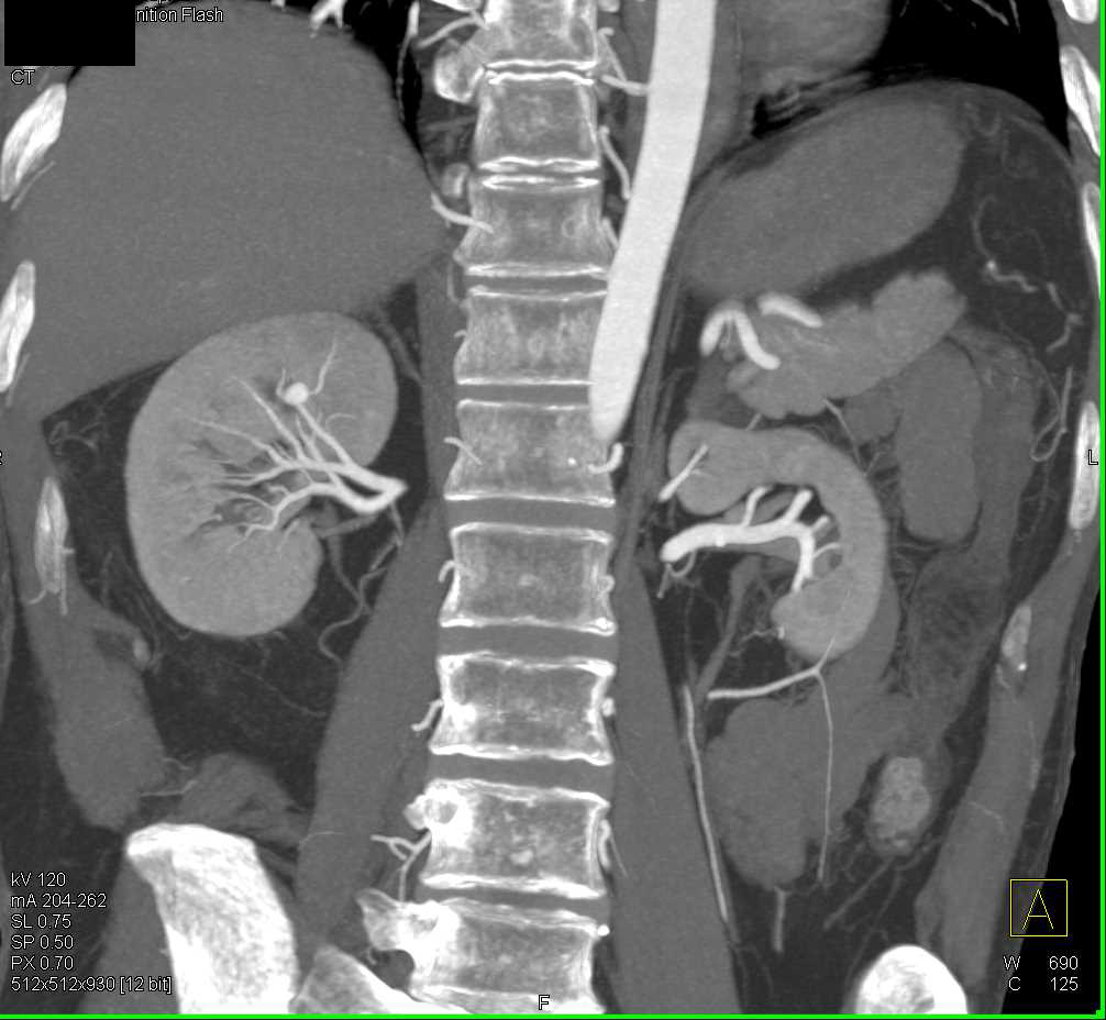 Neurofibromatosis with Right Renal Artery Aneurysm and Multiple Skin Lesions - CTisus CT Scan