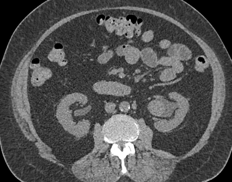 Transitional Cell Carcinoma Left Renal Pelvis and Proximal Ureter - CTisus CT Scan