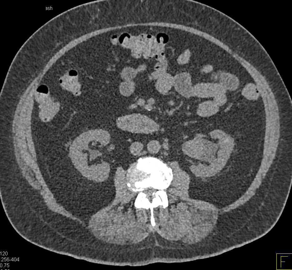 Transitional Cell Carcinoma Left Renal Pelvis and Proximal Ureter - CTisus CT Scan