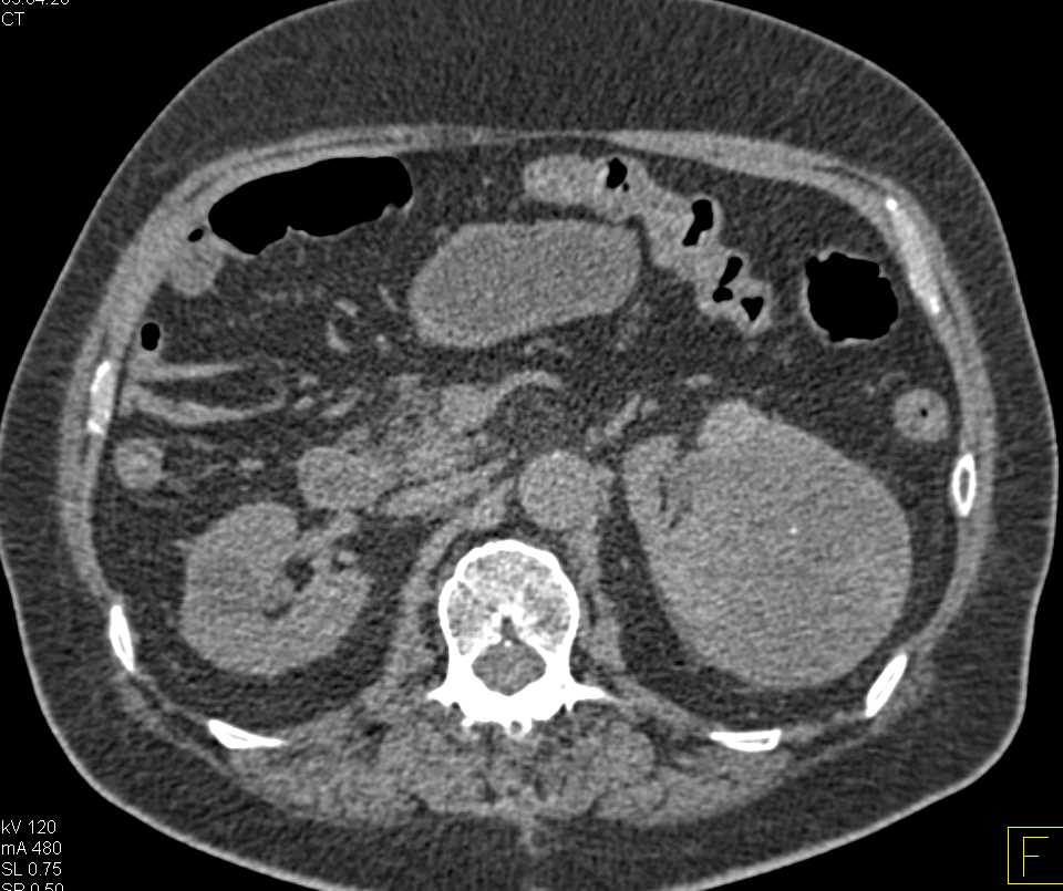 Multifocal Bilateral Papillary Renal Cell Carcinomas - CTisus CT Scan