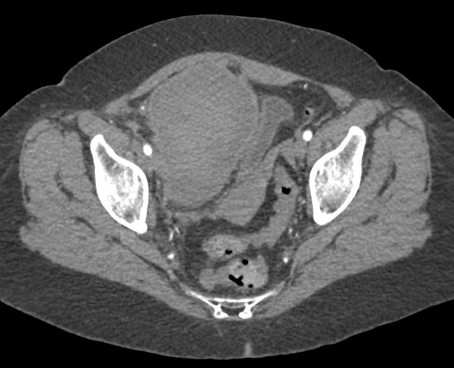 Incidental Fibromuscular Dysplasia (FMD) Right Renal Artery in Patient with Pelvic Hematoma - CTisus CT Scan